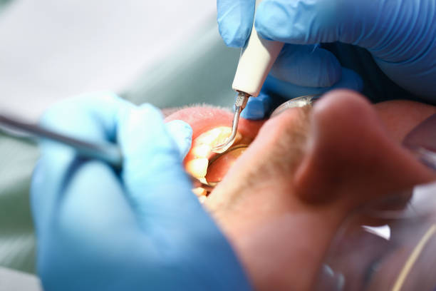 Best Emergency Wisdom Teeth Removal in Hooks, TX