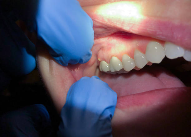 Best Emergency Root Canal Treatment in Hooks, TX